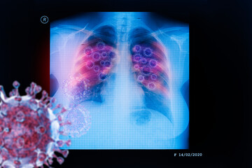 Coronavirus disease COVID-19 virus infection in human lungs