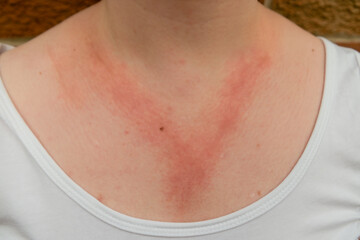 A white lady with allergic contact dermatitis red rash on chest and neck from reaction to nickel jewellery necklace