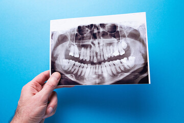 A dentist holding snapshot the patient's tooth and indicates the problem. Panoramic shot of the jaw on a blue isolated background.
