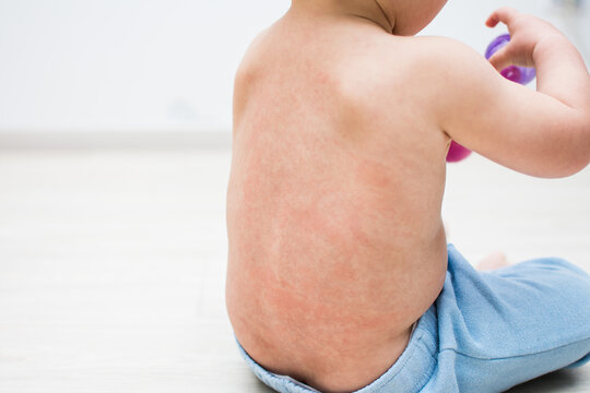 344 Best Roseola Images Stock Photos Vectors Adobe Stock