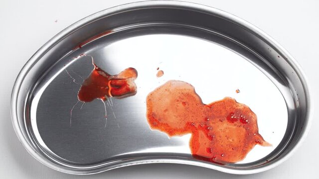 Video of a removed wisdom tooth in a kidney tray