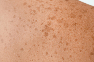 Human skin with freckles, closeup