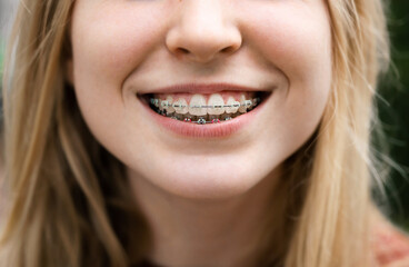 The smiling mouth of a young blonde girl with fixed braces.