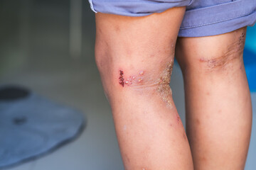 Close up on eczema, skin rash, atopic dermatitis on a boy's legs.