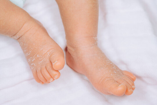 Dry skin on newborn baby feet