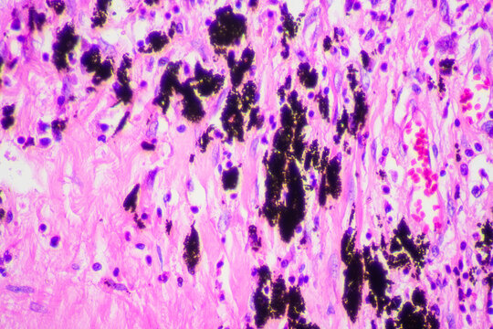 Viral pneumonia disease human cells