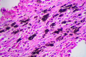 Viral pneumonia disease human cells