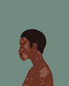 drawing of a girl with vitiligo