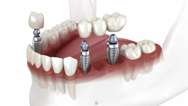 Dental bridge and crown placement over implants. Dental 3D animation concept
