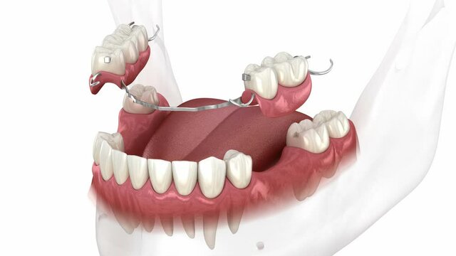 Removable partial denture, mandibular prosthesis. Medically accurate 3D animation of prosthodontics concept