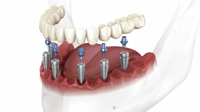 Removable mandibular prosthesis all on 6 system supported by implants. Medically accurate 3D animation of human teeth and dentures