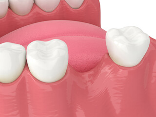 3d render of jaw bone recession after loosing tooth