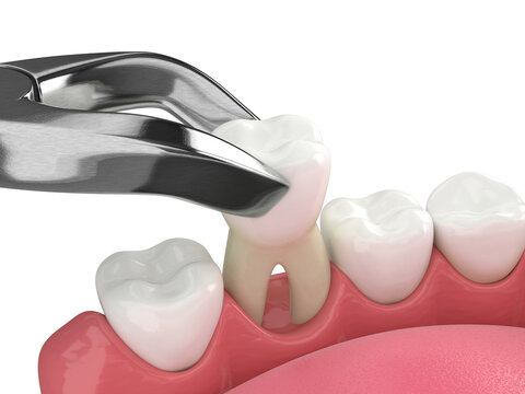 3d render of lower jaw with tooth extraction