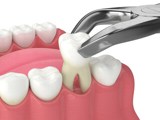 3d render of lower jaw with tooth extraction