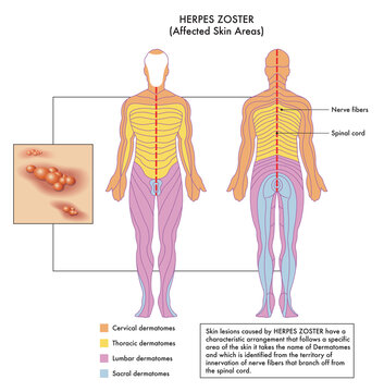 Medical diagram of affected skin areas of Herpes Zoster with annotations.