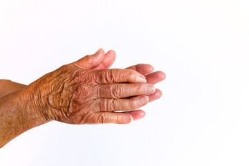 Brown tinted hands with bended fingertips of an elderly woman with Rheumatoid Arthritis disease on...