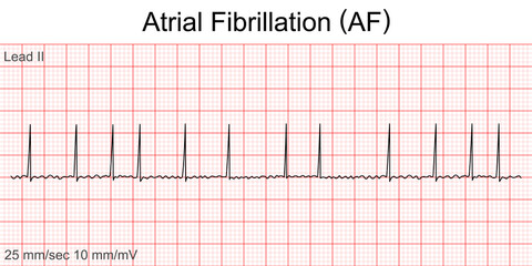 Electrocardiogram show Atrial fibrillation (AF) pattern. Cardiac fibrillation. Heart beat. CPR. ECG. EKG. Vital sign. Life support. Defib. Emergency. Medical healthcare symbol.