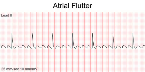Electrocardiogram show Atrial flutter pattern. Cardiac fibrillation. Heart beat. CPR. ECG. EKG. Vital sign. Life support. Defib. Emergency. Medical healthcare symbol. - obrazy, fototapety, plakaty