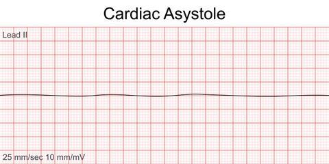 Electrocardiogram show Cardiac asystole pattern. Cardiac fibrillation. Heart beat. CPR. ECG. EKG. Vital sign. Life support. Defib. Emergency. Medical healthcare symbol.