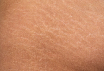 Close up human Skin natural Texture background. Stretch mark Asian woman buttock  - obrazy, fototapety, plakaty