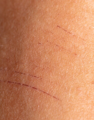 Scratches on human skin as background.