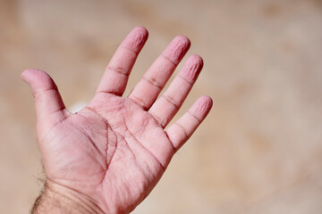 A man shocked with wrinkly and pruney skin of his hands after the bath, or being in water