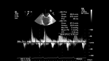 Image of the heart in gray-scale mode during transesophageal ultrasound.