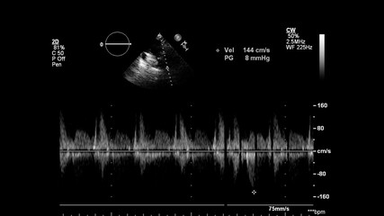 Image of the heart in gray-scale mode during transesophageal ultrasound.