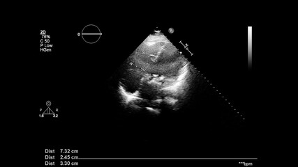 Image of the heart in gray-scale mode during transesophageal ultrasound.