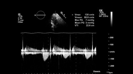 Image of the heart in gray-scale mode during transesophageal ultrasound.