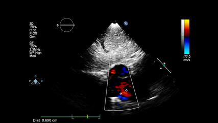 Image of the heart during transesophageal ultrasound with Doppler mode.