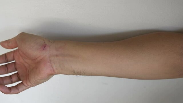 A person's arm shows visible scratches and minor wounds on the skin, suggesting recent injury or contact with a rough surface.