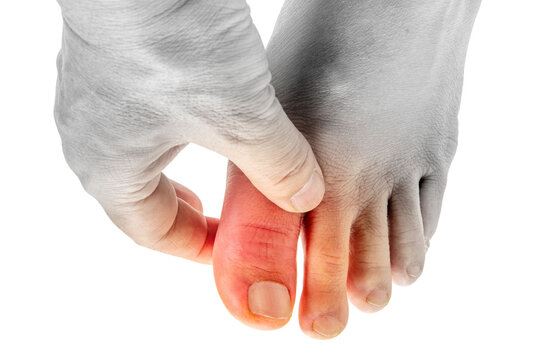 痛風症状の足の親指