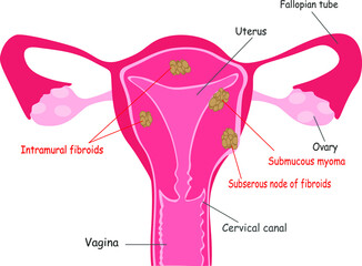 Types of uterine fibroids: intramural, subserosal, and submucosal. Human uterus with benign smooth muscle tumors. myoma