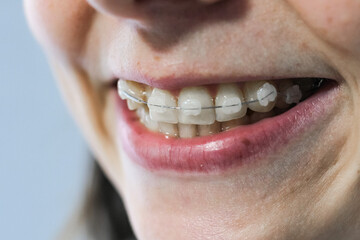 Orthodontic Treatment. Dental Care Concept. Braces system in smiling mouth. Closeup Ceramic and Metal Brackets.