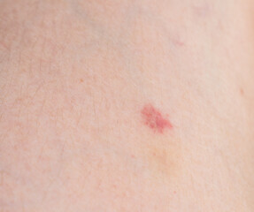 Fototapeta premium small petechiae on the leg. skin lesion concept
