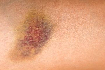 Fototapeta premium Bruise wounded skin texture of asian woman on leg skin body path background