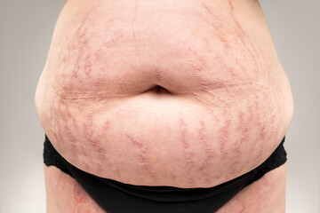 Fat flabby female belly with stretch marks on gray background