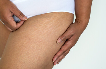 closeup stretch marks on woman buttocks, imperfect natural rough skin on Asian woman - obrazy, fototapety, plakaty