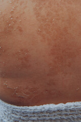 Fototapeta premium baby skin peeling after previously inflamed red