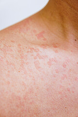 red inflamed skin on a man's body. skin fungus causing white blotches. Atopic eczema