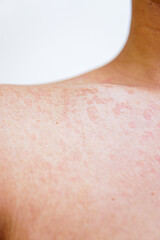 red inflamed skin on a man's body. skin fungus causing white blotches. Atopic eczema