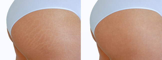 Image compare before and after Woman buttocks with stretch marks removal treatment, real people