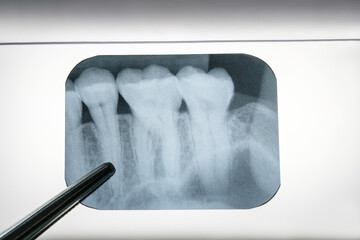 panoramic dental x-ray of a mouth.