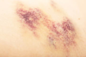 Bruises on the patient's body after injections, bruises under the skin, medical