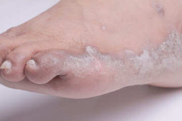 Closeup of the legs of a woman suffering from chronic psoriasis on a white background. Closeup of rash and scaling on the patient's skin. Dermatological problems. Dry skin. Isolated
