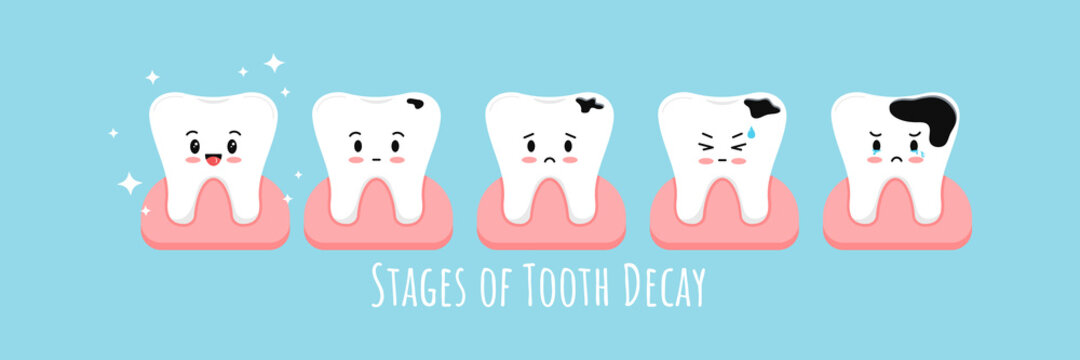 Stages of tooth decay in gum icon set. Cute kawaii teeth on different stages of dental caries development. Flat cartoon emoji character vector illustration. Kids dental hygiene and treatment concept.