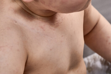 Fototapeta na wymiar roseola rash a viral rash on the skin of a child