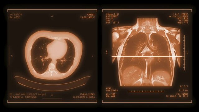 CT Chest or CT Scan of Human Chest Coronal MIP View with Lung filter technique for diagnosis TB,tuberculosis and covid-19 .