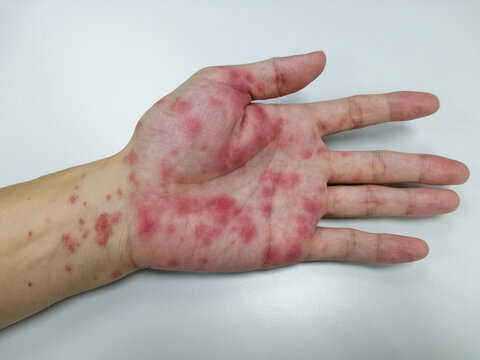 Close up hand with red marks on skin as allergy from dermatitis